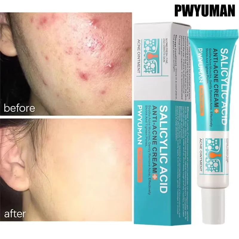 Salicylic Acid Acne Treatment Face Cream – Clearer Skin Starts Here