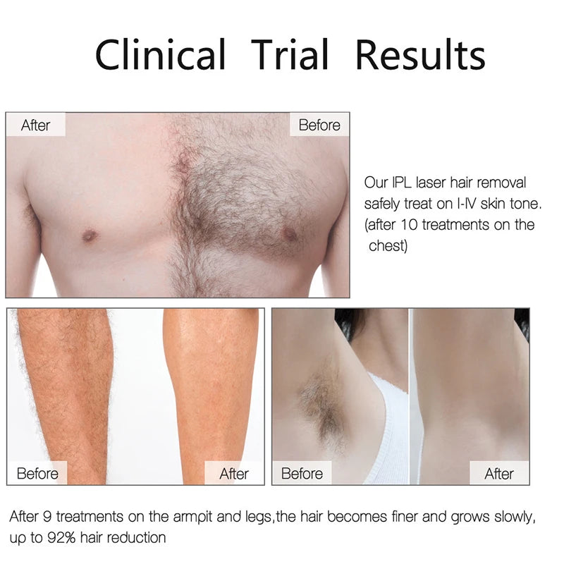 IPL Laser Hair Remover – Professional At-Home