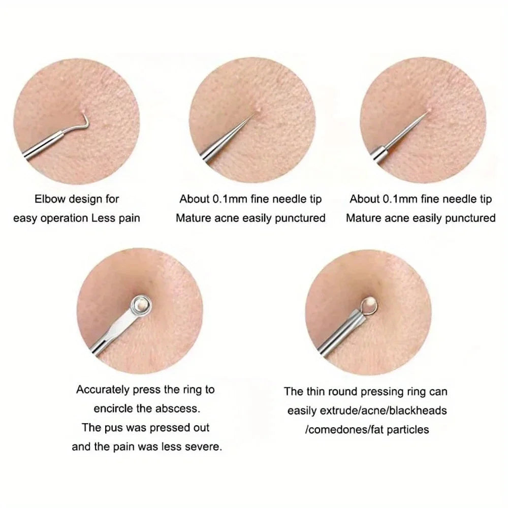 Blackhead Acne Pimple extractor